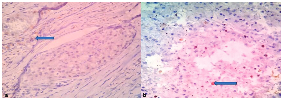 (a) Estrogen receptor (ER) 2+ positivity (blue arrow; 40x). (b) Ki-67: 22% positivity (blue arrow; 40x).
